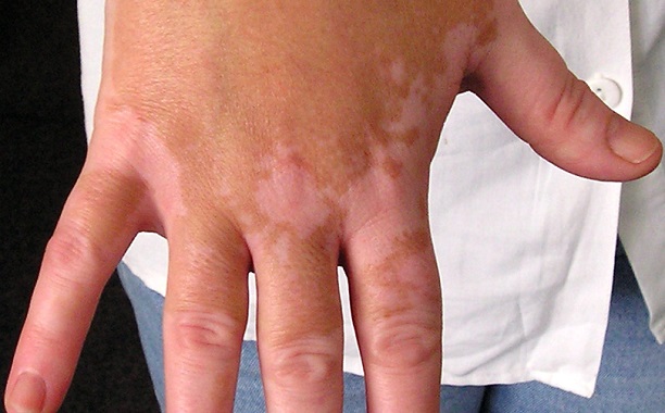 Vitiligo Disease